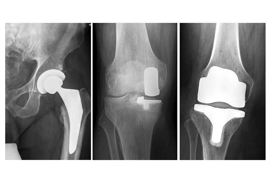Röntgenbilder einer Hüft-Totalendoprothese, einer Schlittenprothese am Kniegelenk und einer Knietotalendoprothese